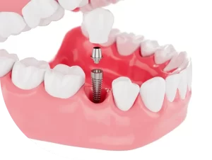 Implant Dentist Wollongong